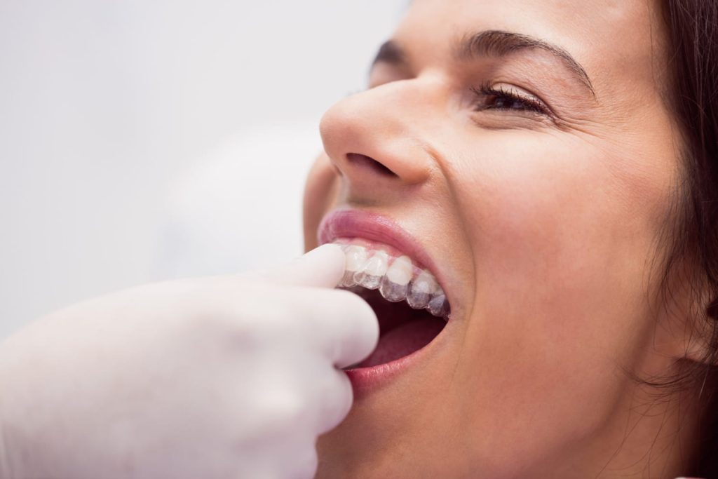 ortodoncia invisible y brackets clinica dental trunser cadiz